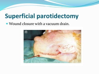 Superficial parotidectomy
 Wound closure with a vacuum drain.
 