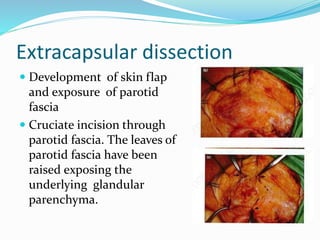 Extracapsular dissection
 Development of skin flap
and exposure of parotid
fascia
 Cruciate incision through
parotid fascia. The leaves of
parotid fascia have been
raised exposing the
underlying glandular
parenchyma.
 