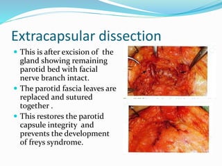 Extracapsular dissection
 This is after excision of the
gland showing remaining
parotid bed with facial
nerve branch intact.
 The parotid fascia leaves are
replaced and sutured
together .
 This restores the parotid
capsule integrity and
prevents the development
of freys syndrome.
 