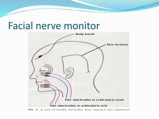 Facial nerve monitor
 