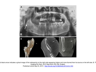 nd black arrow indicates a ghost image of the radiopacity on the right side appearing higher and more blurred than its source on the left side. B. Th
Imaging Sci Dent. 2013 Sep;43(3):163-169. English.
Published online Sep 23, 2013. http://dx.doi.org/10.5624/isd.2013.43.3.163
 
