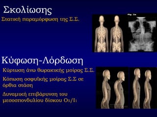 Σκολίωσης
Στατική παραμόρφωση της Σ.Σ.Στατική παραμόρφωση της Σ.Σ.
Κύφωση-Λόρδωση
Κύρτωση άνω θωρακικής μοίρας Σ.Σ.
Κόπωση οσφυϊκής μοίρας Σ.Σ σε
όρθια στάση
Δυναμική επιβάρυνση του
μεσοσπονδυλίου δίσκου Ο5/Ι1
 