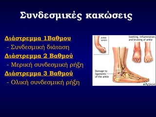 Συνδεσμικές κακώσεις
Διάστρεμμα 1Βαθμου
- Συνδεσμική διάταση
Διάστρεμμα 2 Βαθμού
- Μερική συνδεσμική ρήξη
Διάστρεμμα 3 Βαθμού
- Ολική συνδεσμική ρήξη
 