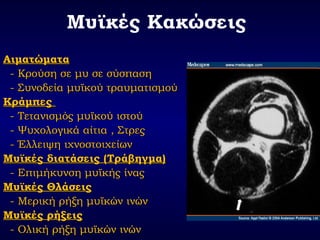 Μυϊκές Κακώσεις
ΑιματώματαΑιματώματα
- Κρούση σε μυ σε σύσπαση- Κρούση σε μυ σε σύσπαση
- Συνοδεία μυϊκού τραυματισμού- Συνοδεία μυϊκού τραυματισμού
ΚράμπεςΚράμπες
- Τετανισμός μυϊκού ιστού- Τετανισμός μυϊκού ιστού
- Ψυχολογικά αίτια , Στρες- Ψυχολογικά αίτια , Στρες
- Έλλειψη ιχνοστοιχείων- Έλλειψη ιχνοστοιχείων
Μυϊκές διατάσεις (Τράβηγμα)Μυϊκές διατάσεις (Τράβηγμα)
- Επιμήκυνση μυϊκής ίνας- Επιμήκυνση μυϊκής ίνας
Μυϊκές ΘλάσειςΜυϊκές Θλάσεις
- Μερική ρήξη μυϊκών ινών- Μερική ρήξη μυϊκών ινών
Μυϊκές ρήξειςΜυϊκές ρήξεις
- Ολική ρήξη μυϊκών ινών- Ολική ρήξη μυϊκών ινών
 