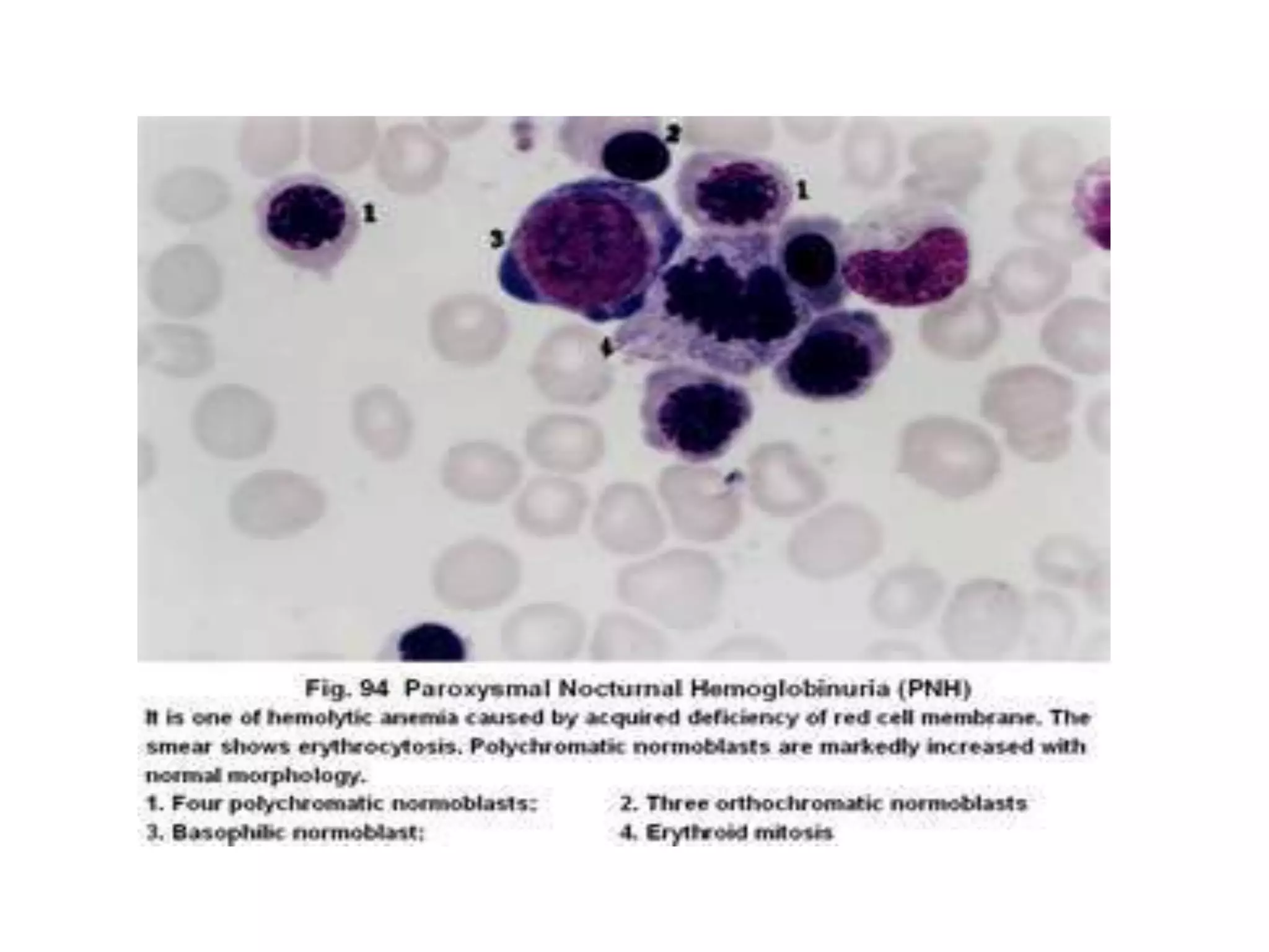 Paroxysmal nocturnal hemoglobinuria | PPTX