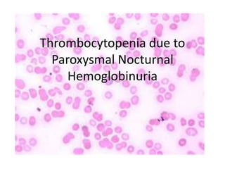 Thrombocytopenia due to
  Paroxysmal Nocturnal
     Hemoglobinuria
 