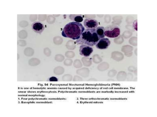 Paroxysmal nocturnal hemoglobinuria | PPTX | Blood Disorders | Diseases ...