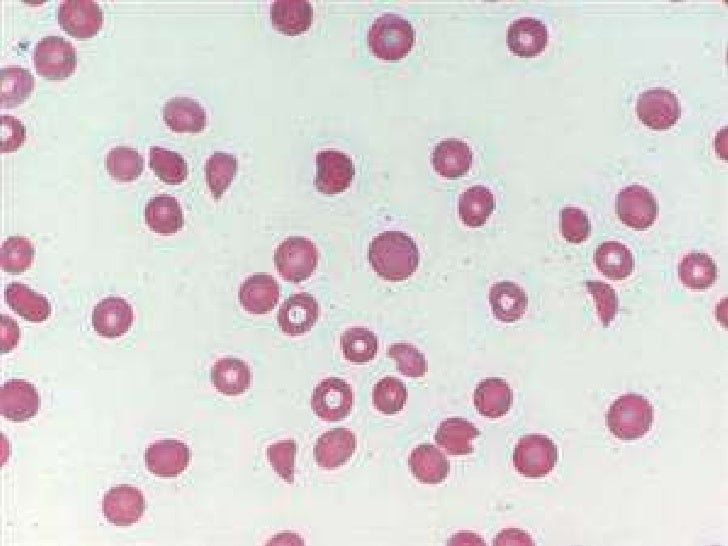 paroxysmal-nocturnal-hemoglobinuria