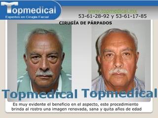 www.topmedical.mx
53-61-28-92 y 53-61-17-85
Es muy evidente el beneficio en el aspecto, este procedimiento
brinda al rostro una imagen renovada, sana y quita años de edad
CIRUGÍA DE PÁRPADOS
 