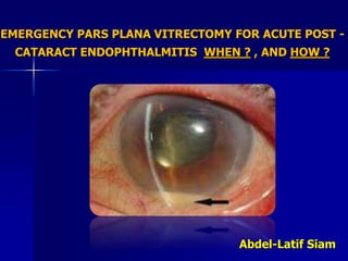 EMERGENCY PARS PLANA VITRECTOMY FOR ACUTE POST -
CATARACT ENDOPHTHALMITIS WHEN ? , AND HOW ?
Abdel-Latif Siam
 