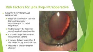 Risk factors for lens drop-intraoperative
 SURGEON’S EXPERIENCE AND
INSTRUMENTS
 Posterior extention of capsular
tear du...