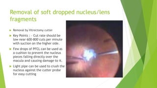 Removal/Delivery via limbal route
 Vitrectomy as stated earlier
 Elevating Nucleus by active
suction with the hard tip f...