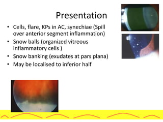 Presentation
• Cells, flare, KPs in AC, synechiae (Spill
over anterior segment inflammation)
• Snow balls (organized vitreous
inflammatory cells )
• Snow banking (exudates at pars plana)
• May be localised to inferior half
 