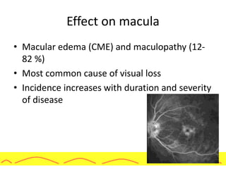 Effect on macula
• Macular edema (CME) and maculopathy (12-
82 %)
• Most common cause of visual loss
• Incidence increases with duration and severity
of disease
 