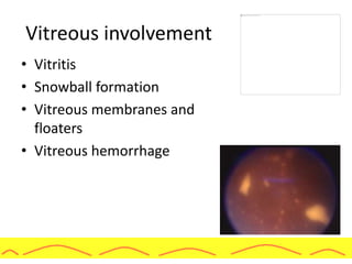 Vitreous involvement
• Vitritis
• Snowball formation
• Vitreous membranes and
floaters
• Vitreous hemorrhage
 
