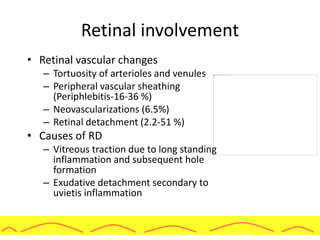 Retinal involvement
• Retinal vascular changes
– Tortuosity of arterioles and venules
– Peripheral vascular sheathing
(Periphlebitis-16-36 %)
– Neovascularizations (6.5%)
– Retinal detachment (2.2-51 %)
• Causes of RD
– Vitreous traction due to long standing
inflammation and subsequent hole
formation
– Exudative detachment secondary to
uvietis inflammation
 