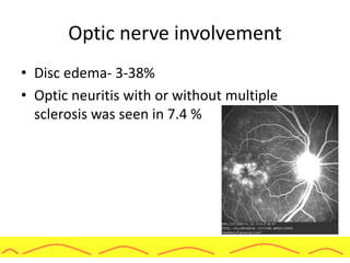 Optic nerve involvement
• Disc edema- 3-38%
• Optic neuritis with or without multiple
sclerosis was seen in 7.4 %
 