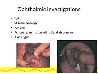 Ophthalmic investigations
• V/A
• SL biomicroscopy
• IOP and
• Fundus examination with scleral depression
• Amsler grid
 