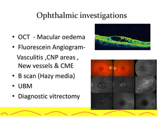 • OCT - Macular oedema
• Fluorescein Angiogram-
Vasculitis ,CNP areas ,
New vessels & CME
• B scan (Hazy media)
• UBM
• Diagnostic vitrectomy
Ophthalmic investigations
 