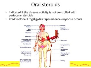 Oral steroids
• Indicated if the disease activity is not controlled with
periocular steroids
• Prednisolone 1 mg/kg/day tapered once response occurs
 