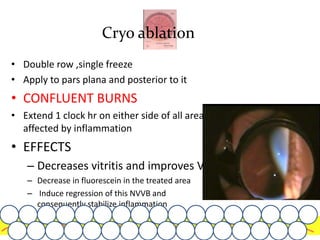 • Double row ,single freeze
• Apply to pars plana and posterior to it
• CONFLUENT BURNS
• Extend 1 clock hr on either side of all areas
affected by inflammation
• EFFECTS
– Decreases vitritis and improves VA
– Decrease in fluorescein in the treated area
– Induce regression of this NVVB and
consequently stabilize inflammation
Cryo ablation
 