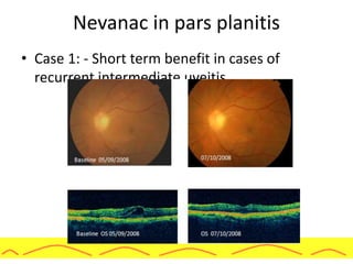 Nevanac in pars planitis
• Case 1: - Short term benefit in cases of
recurrent intermediate uveitis
 