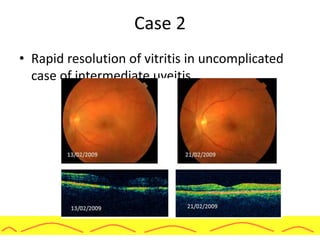 Case 2
• Rapid resolution of vitritis in uncomplicated
case of intermediate uveitis
 