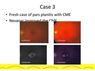 Case 3
• Fresh case of pars planitis with CME
• Nevanac improved the CME
 