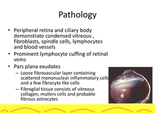 Pathology
• Peripheral retina and ciliary body
demonstrate condensed vitreous ,
fibroblasts, spindle cells, lymphocytes
and blood vessels
• Prominent lymphocyte cuffing of retinal
veins
• Pars plana exudates
– Loose fibrovascular layer containing
scattered mononuclear inflammatory cells
and a few fibrocyte like cells
– Fibroglial tissue consists of vitreous
collagen, mullers cells and probable
fibrous astrocytes
 