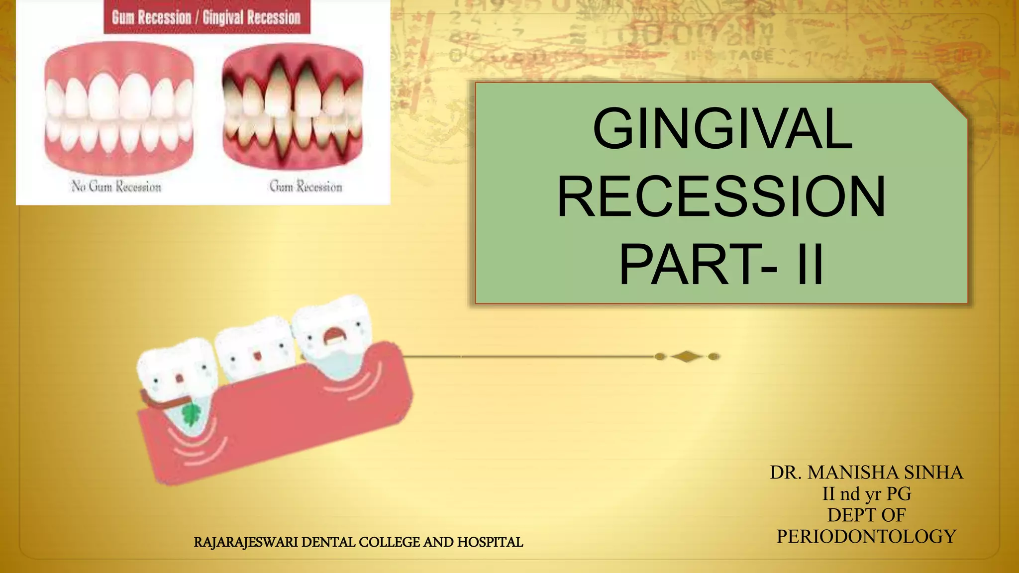 Gingival recession part 2 | PPTX