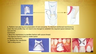 e. Perform root planing and preparation of root concavity. If a titanium-reinforced membrane is
used, the root profile may not need to be changed to establish the required space between the
root and the
membrane
f. Bend the membrane in a tentlike fashion with suture thread.
The titanium frame is bent to create space
under the membrane.
g. Stabilize the membrane
with a sling suture.
 