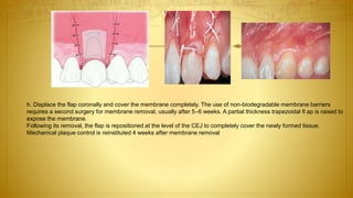 h. Displace the flap coronally and cover the membrane completely. The use of non-biodegradable membrane barriers
requires a second surgery for membrane removal, usually after 5–6 weeks. A partial thickness trapezoidal fl ap is raised to
expose the membrane.
Following its removal, the flap is repositioned at the level of the CEJ to completely cover the newly formed tissue.
Mechanical plaque control is reinstituted 4 weeks after membrane removal
 