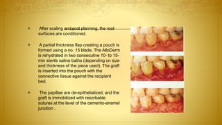 After scaling and root planning, the root
surfaces are conditioned.
 A partial thickness flap creating a pouch is
formed using a no. 15 blade. The AlloDerm
is rehydrated in two consecutive 10- to 15-
min sterile saline baths (depending on size
and thickness of the piece used). The graft
is inserted into the pouch with the
connective tissue against the recipient
bed.
 The papillae are de-epithelialized, and the
graft is immobilized with resorbable
sutures at the level of the cemento-enamel
junction .
 