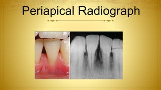 Periapical Radiograph
 