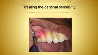 Treating the dentinal sensitivity
 