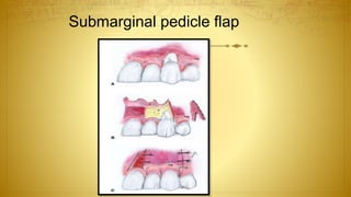 Submarginal pedicle flap
 