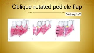 Oblique rotated pedicle flap
Dhalberg,1969
 