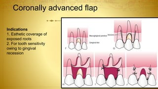 Coronally advanced flap
Indications
1. Esthetic coverage of
exposed roots
2. For tooth sensitivity
owing to gingival
recession
 