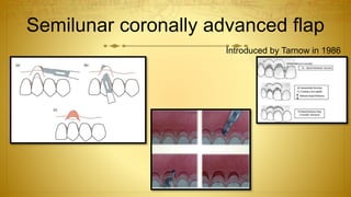 Semilunar coronally advanced flap
Introduced by Tarnow in 1986
 