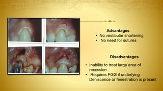 Advantages
• No vestibular shortening
• No need for sutures
Disadvantages
• Inability to treat large area of
recession
• Requires FGG if underlying
Dehiscence or fenestration is present
 