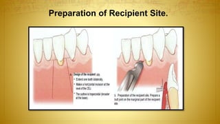 Preparation of Recipient Site.
 