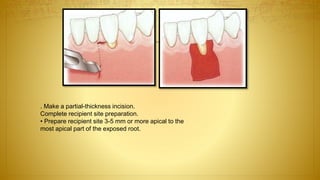 . Make a partial-thickness incision.
Complete recipient site preparation.
• Prepare recipient site 3-5 mm or more apical to the
most apical part of the exposed root.
 