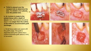 a. Tinfoil is placed over the
recipient site to determine the
size. The tinfoil is then placed
over the palatal area.
b. An incision is made to the
palatal tissue with a depth of
about 2 mm. The incision should be
about 1 mm larger than the outline
of the tinfoil to accommodate graft
shrinkage.
c. Small tissue pliers are used to lift
the graft's edge. The graft is
separated along the outline and a
uniform-thickness graft (about 2 mm)
is harvested.
 