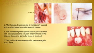 d. After harvest, the donor site is immediately sutured
and an absorbable hemostat gauze is placed.
e. The harvested graft is placed onto a gauze soaked
with physiologic saline solution. The thickness of the
adipose tissue and glandular tissue is checked.
f. The graft thickness necessary for root coverage is
1.5-2.5 mm.
 