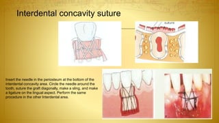 Insert the needle in the periosteum at the bottom of the
interdental concavity area. Circle the needle around the
tooth, suture the graft diagonally, make a sling, and make
a ligature on the lingual aspect. Perform the same
procedure in the other Interdental area.
Interdental concavity suture
 