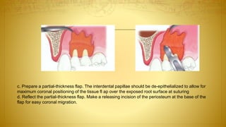 c. Prepare a partial-thickness flap. The interdental papillae should be de-epithelialized to allow for
maximum coronal positioning of the tissue fl ap over the exposed root surface at suturing
d. Reflect the partial-thickness flap. Make a releasing incision of the periosteum at the base of the
flap for easy coronal migration.
 