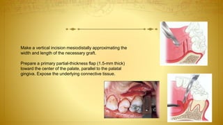 Make a vertical incision mesiodistally approximating the
width and length of the necessary graft.
Prepare a primary partial-thickness flap (1.5-mm thick)
toward the center of the palate, parallel to the palatal
gingiva. Expose the underlying connective tissue.
 