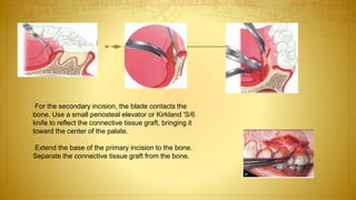 For the secondary incision, the blade contacts the
bone. Use a small periosteal elevator or Kirkland 'S/6
knife to reflect the connective tissue graft, bringing it
toward the center of the palate.
Extend the base of the primary incision to the bone.
Separate the connective tissue graft from the bone.
 