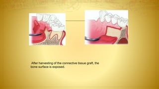 After harvesting of the connective tissue graft, the
bone surface is exposed.
 