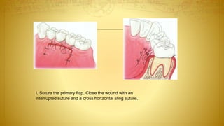 I. Suture the primary flap. Close the wound with an
interrupted suture and a cross horizontal sling suture.
 